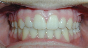 teeth treatment