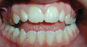 teeth treatment