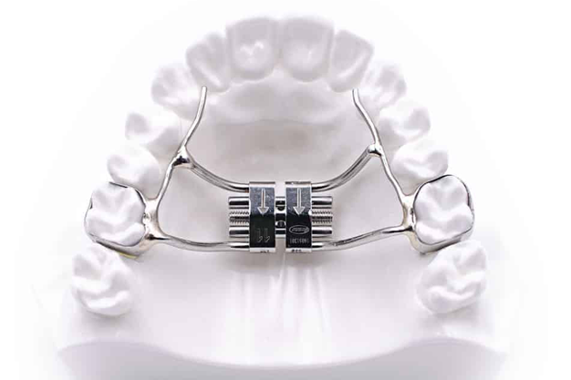 Instructions to Activate the Rapid Palatal  Expander