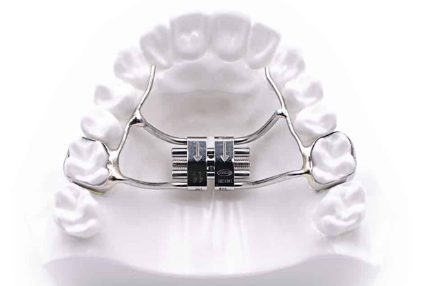 Treatment Options to Manage Teeth Crowding in Children