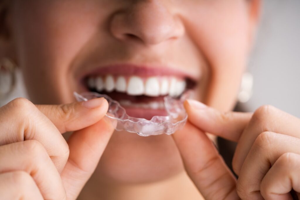ALIGNER USE AND CARE GUIDE for your Ormco™ Spark™ aligners